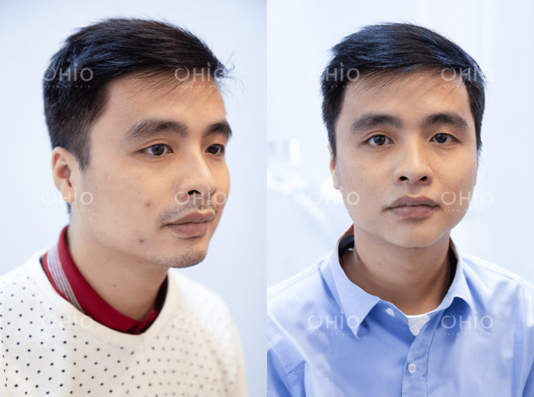 Anh Nguyễn Minh (29 tuổi) triệt sạch râu mép, cằm sau liệu trình ngắn