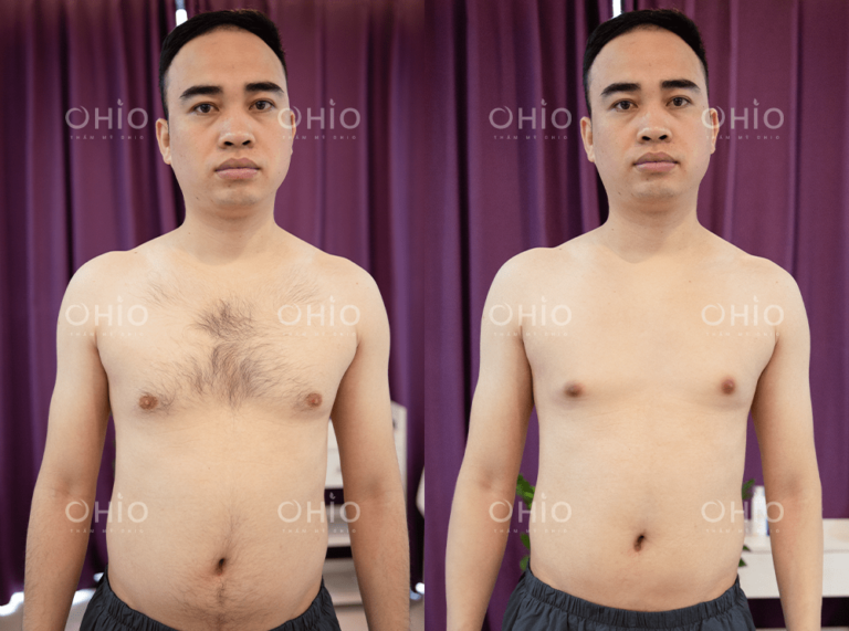 Anh Đào Xuân (30 tuổi) triệt sạch lông ngực, bụng sau liệu trình ngắn