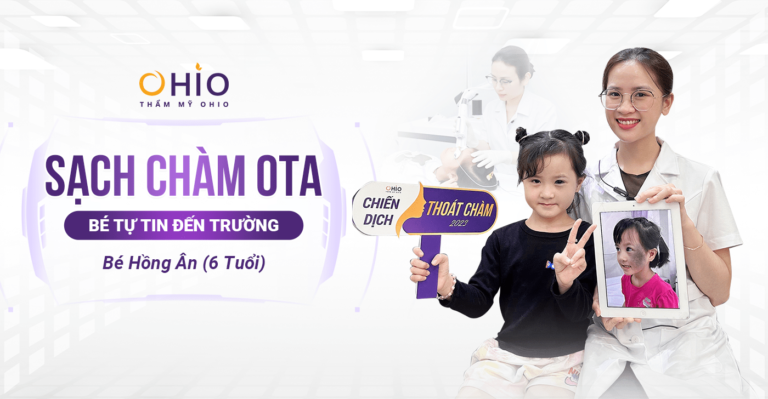 Điều trị chàm bớt sắc tố - Phòng khám da liễu OHIO Hồng Ân (6 tuổi): Sạch chàm sắc tố OTA xanh đen bé tự tin đến trường