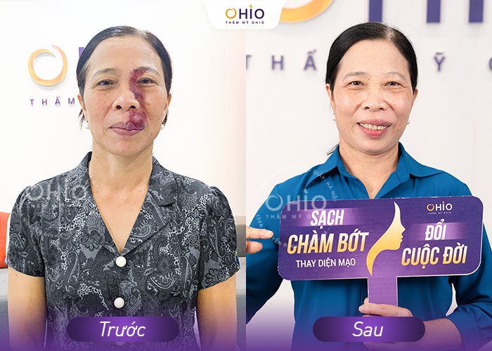 Điều trị chàm bớt đỏ - Phòng khám da liễu OHIO Trước và sau điều trị chàm bớt đỏ tại OHIO