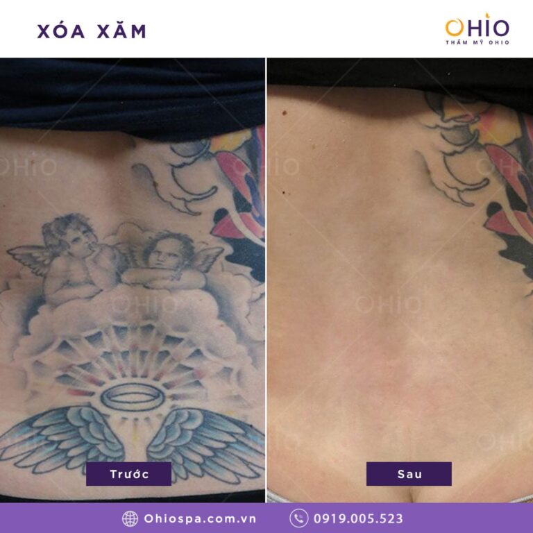 Địa chỉ xóa xăm uy tín ở Hà Nội, cam kết sạch màu và