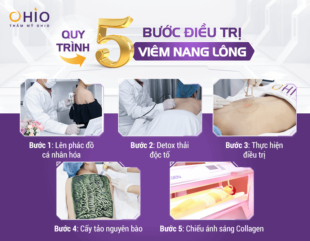 Quy trình điều trị viêm nang lông tại OHIO