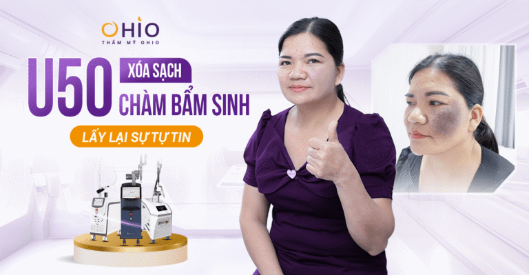 Chị Sự (Hà Nội): Xóa sạch chàm đen lấy lại tự tin sau 50 năm