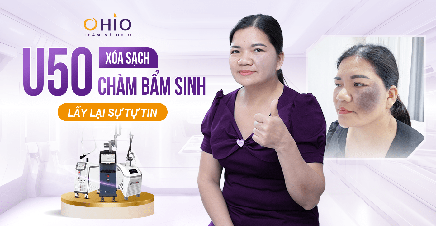 Chị Sự (Hà Nội): Xóa sạch chàm đen lấy lại tự tin sau 50 năm