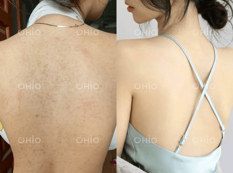 Chị Hồng Nga (25 tuổi) trị sạch viêm nang lông vùng lưng sau 1 liệu trình