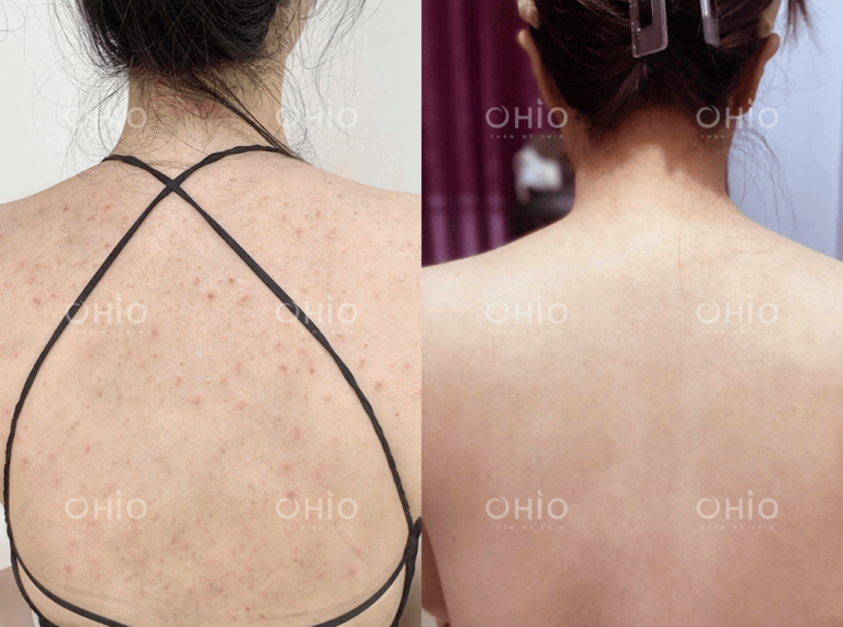 Chị Thu Sương (32 tuổi) trị sạch viêm nang lông vùng lưng sau 1 liệu trình