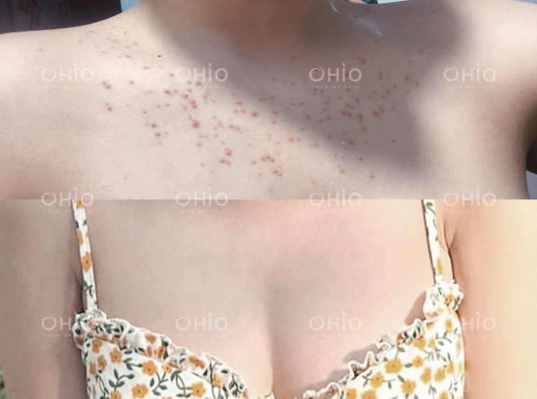 Chị Nguyệt Hoa (32 tuổi) trị dứt điểm viêm nang lông vùng ngực