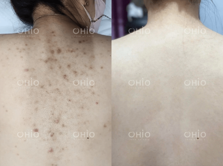 Chị Ánh Quỳnh (26 tuổi) trị sạch viêm nang lông, thâm mụn vùng lưng