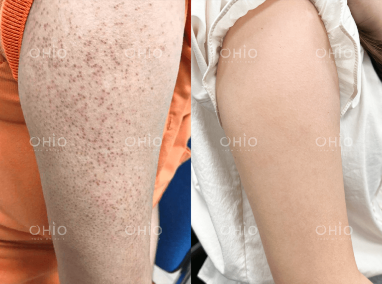 Chị Ngọc Thảo (31 tuổi) trị dứt điểm viêm nang lông cấp độ nặng vùng cánh tay