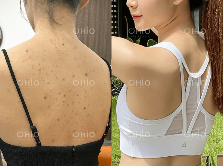 Chị Ngọc Kim (25 tuổi) trị sạch viêm nang lông, thâm mụn vùng lưng
