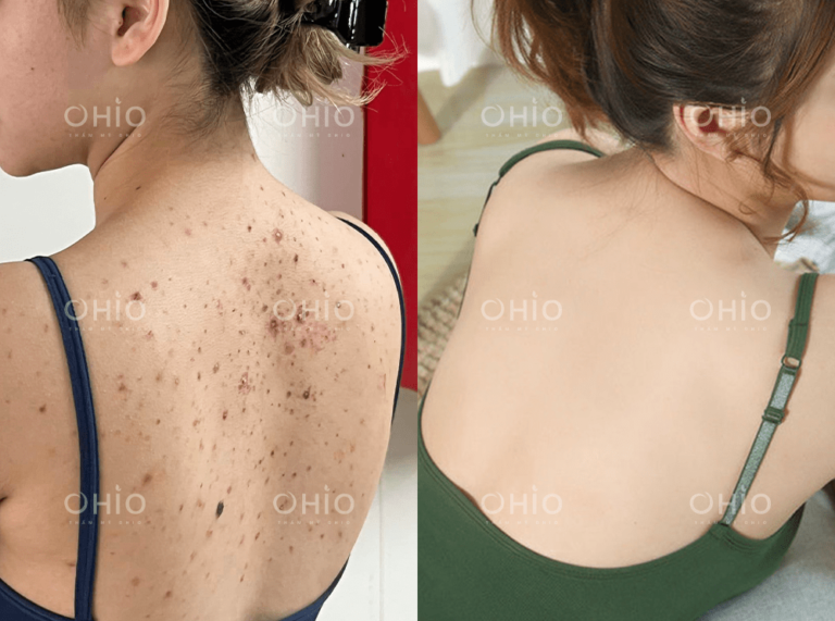 Chị Quỳnh Chi (28 tuổi) sạch viêm nang lông, thâm mụn sau 1 liệu trình
