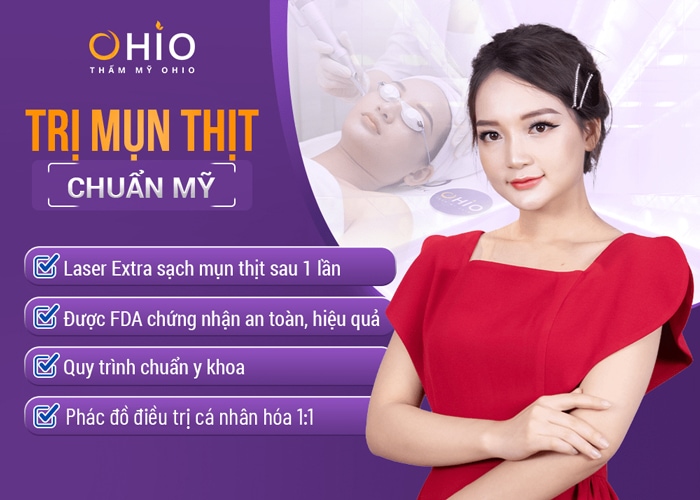 Điều trị mụn thịt Laser Extra: Hiệu quả, nhanh chóng, an toàn,