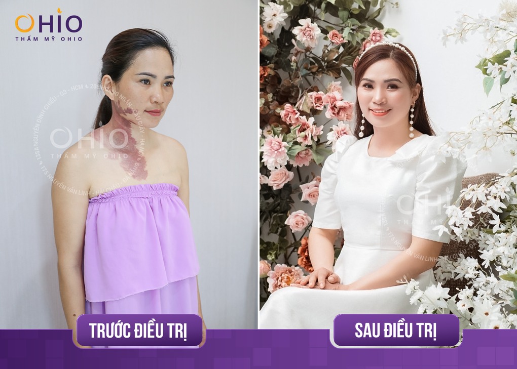 Điều trị chàm bớt sắc tố - Phòng khám da liễu OHIO Trước và sau điều trị chàm bớt sắc tố tại OHIO