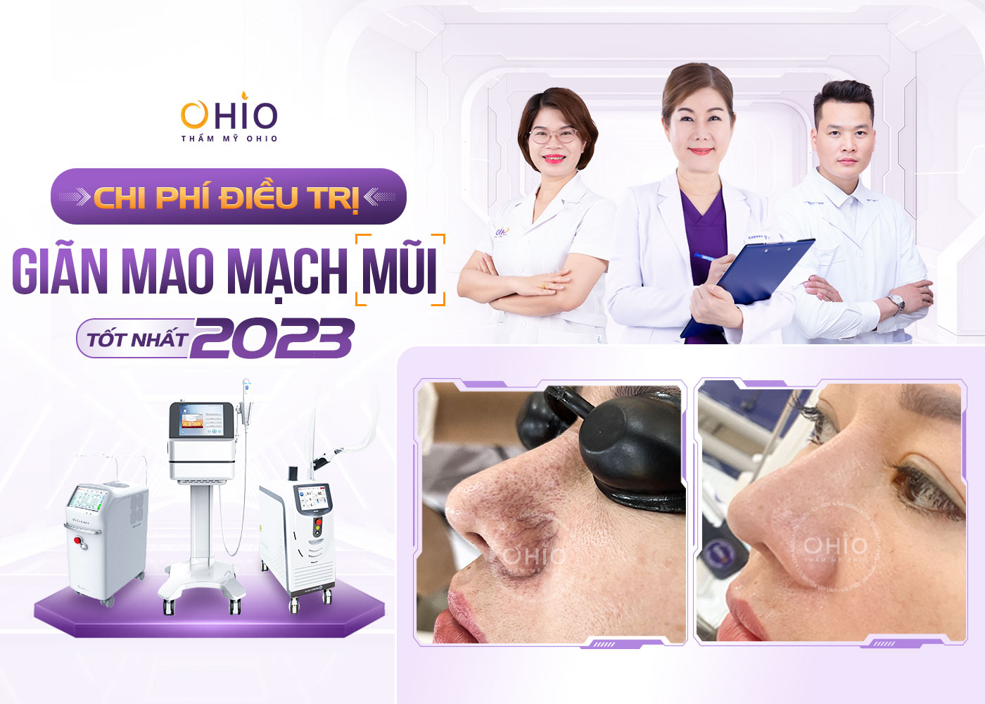 Chi phí điều trị Giãn mao mạch Mũi năm 2025