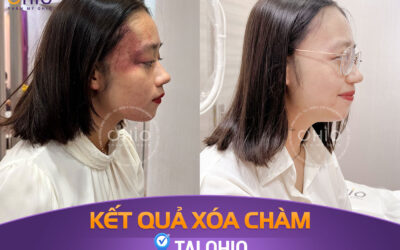 Điều trị chàm bớt sắc tố