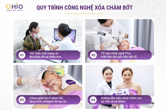 Điều trị chàm bớt sắc tố - Phòng khám da liễu OHIO Quy trình điều trị chàm bớt sắc tố tại OHIO