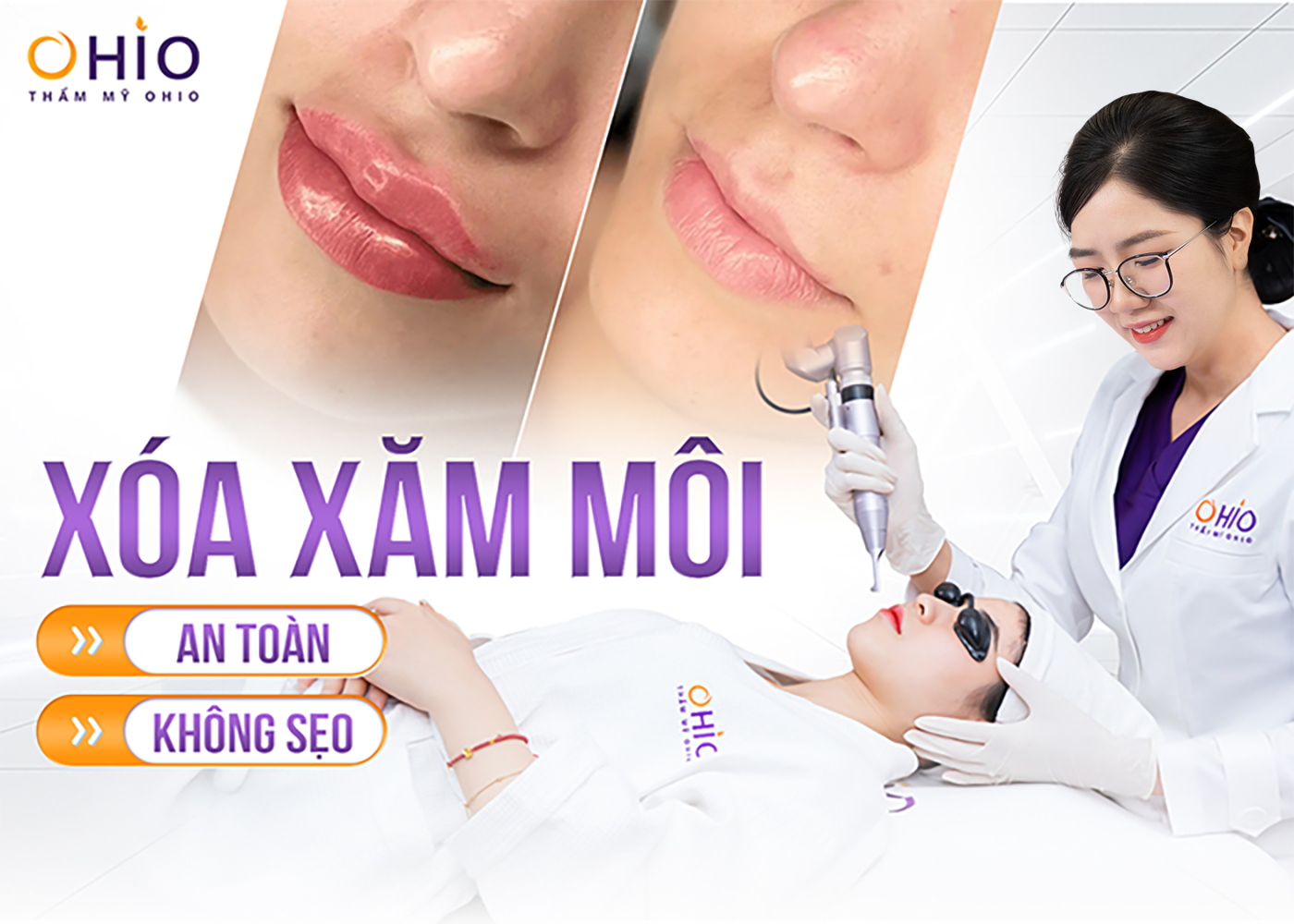 Xóa xăm môi hiệu quả – tối ưu thời gian