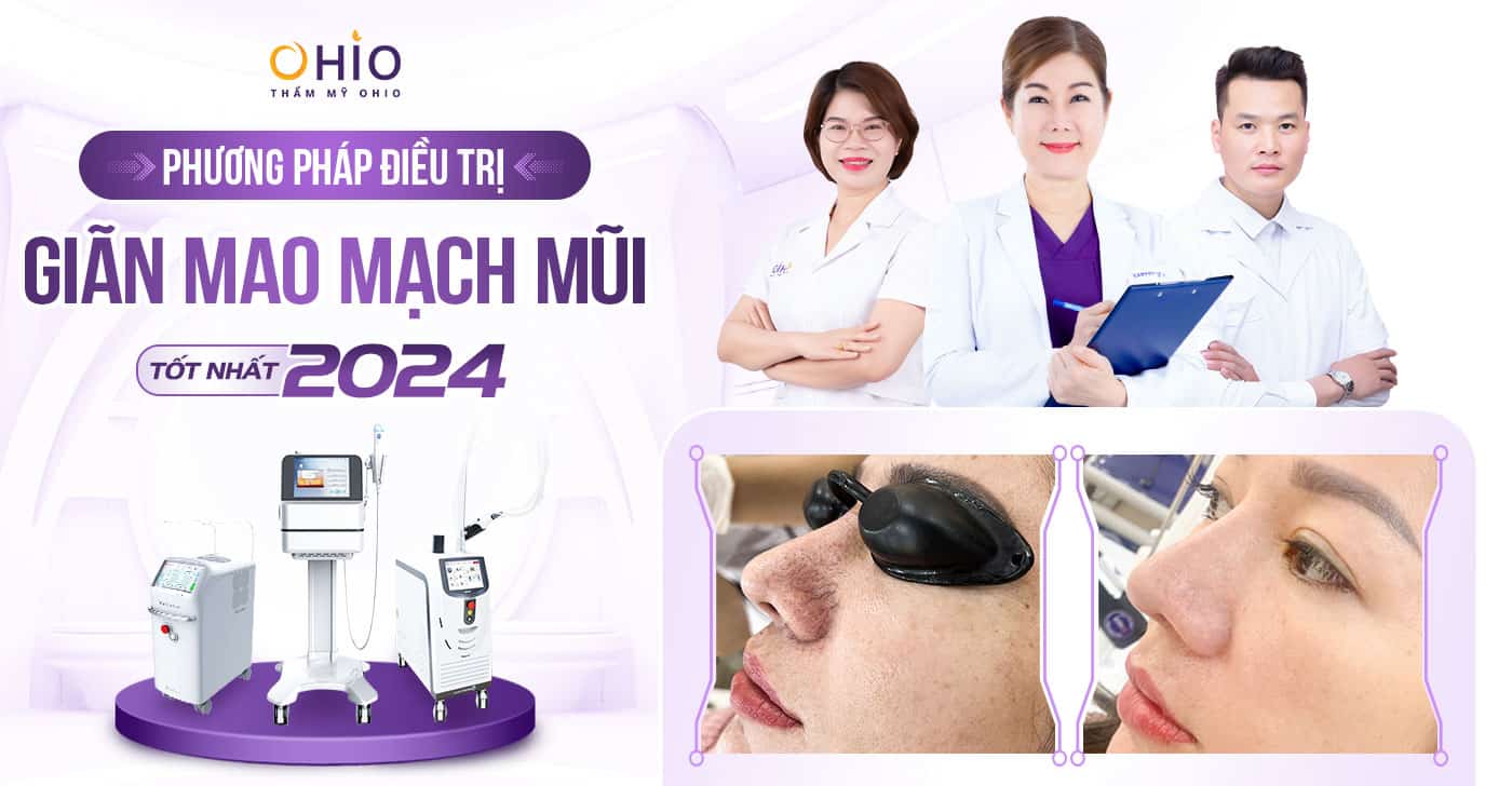 Phương pháp điều trị Giãn mao mạch Mũi tốt 2025