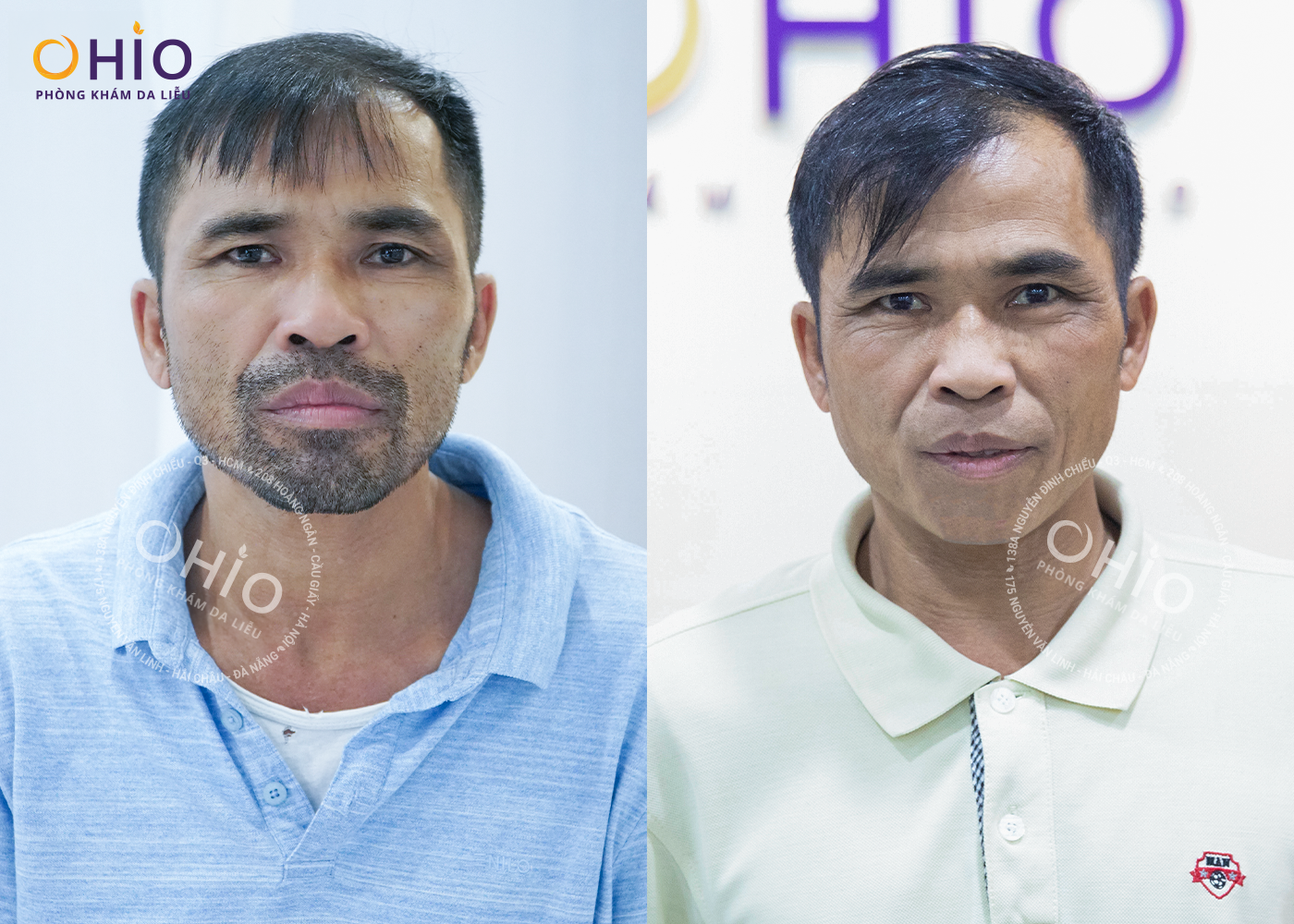 Triệt lông  giá bao nhiêu