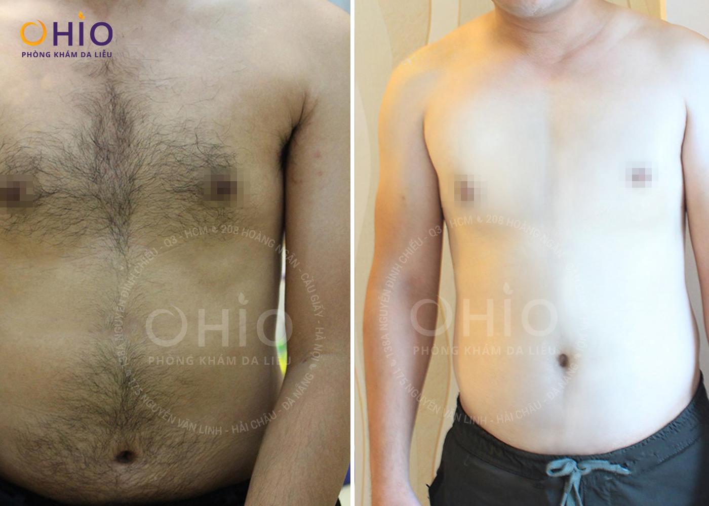 Triệt lông bằng laser cần lưu ý gì?