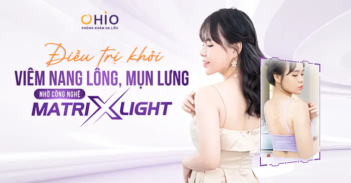 Chị Hoàng Huyền: Hành trình vượt qua nỗi ám ảnh mang tên “Viêm nang lông”