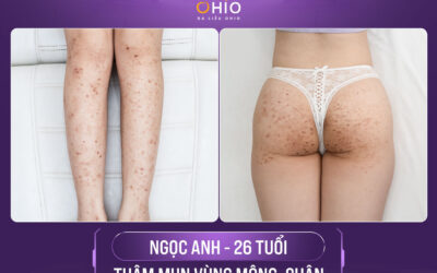 Điều trị vết thâm sạm trên da