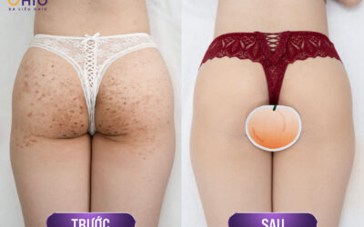 Điều trị vết thâm sạm trên da