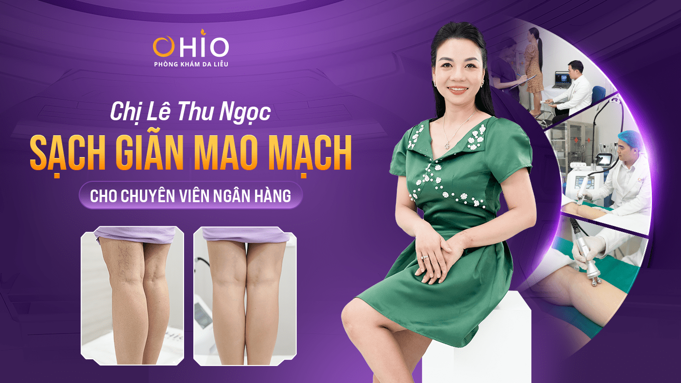 Chị Thu Ngọc: Trải nghiệm Tổ hợp công nghệ laser xung dài trị giãn mao mạch tại OHIO