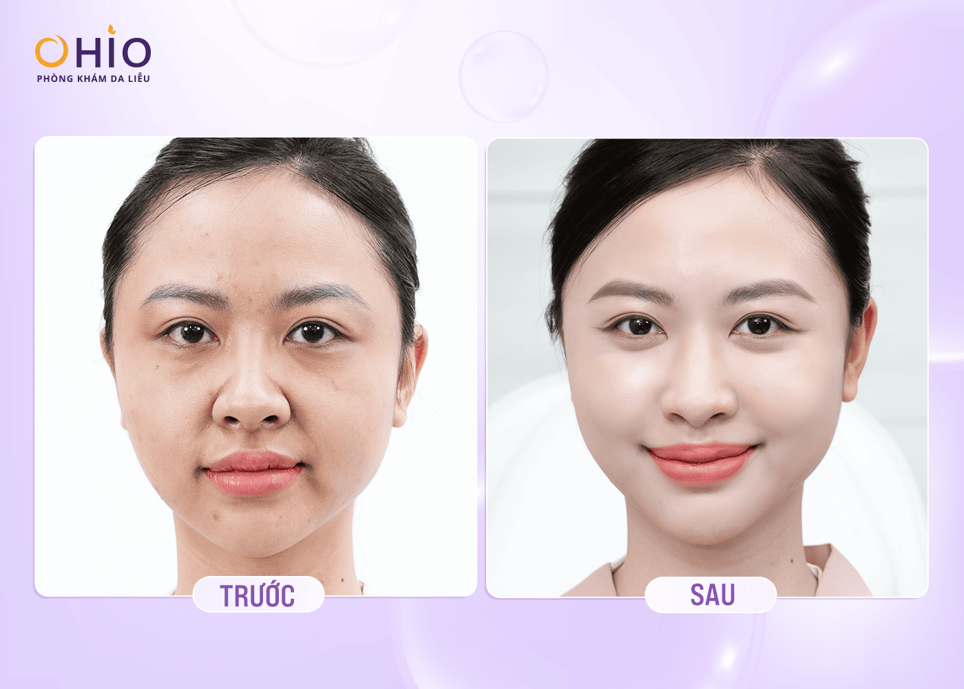 Trẻ hóa, xóa nhăn bằng Meso / HA / BAP - Phòng khám da liễu OHIO Kết quả trẻ hóa nền da tại OHIO