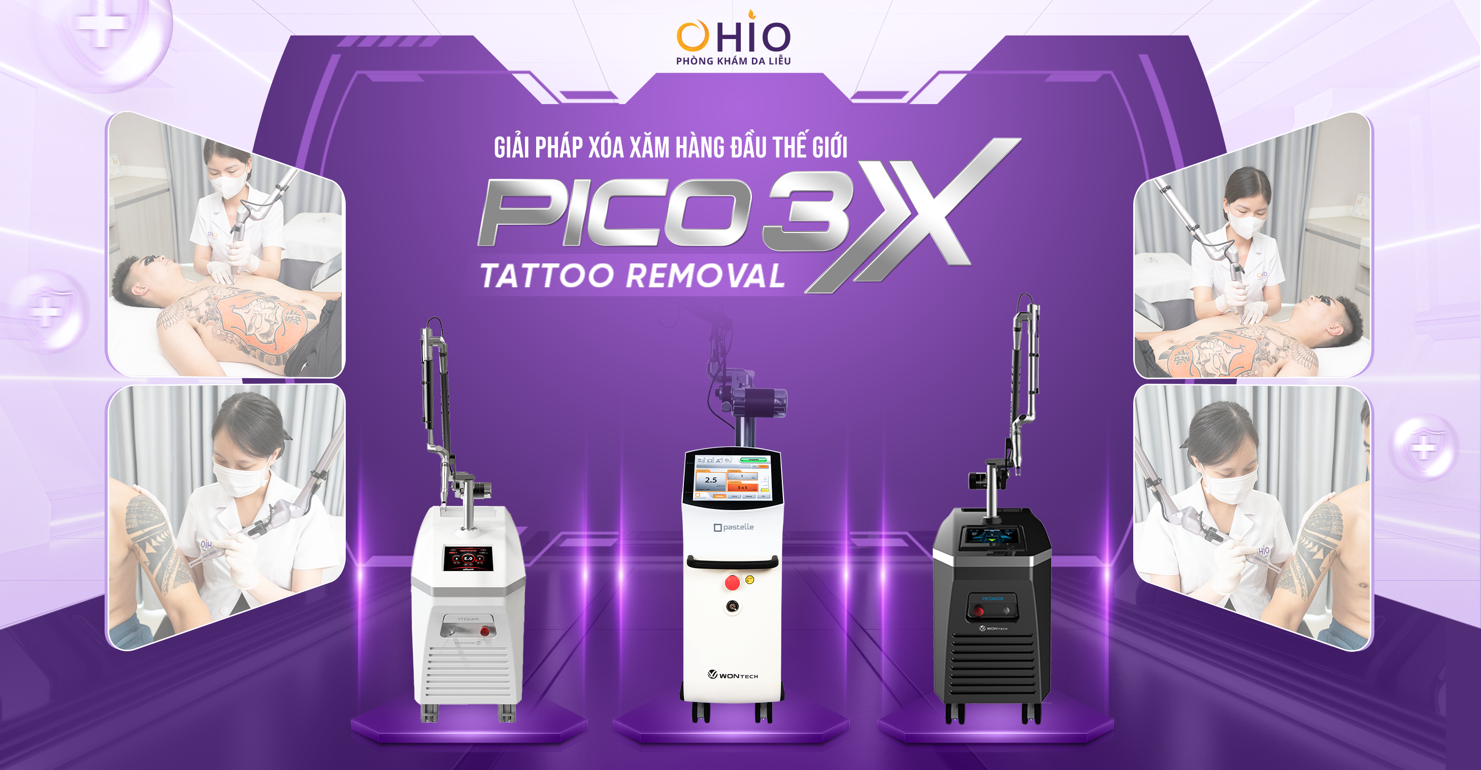 Xóa xăm Piconew 450 – Công nghệ xóa xăm tại phòng khám OHIO