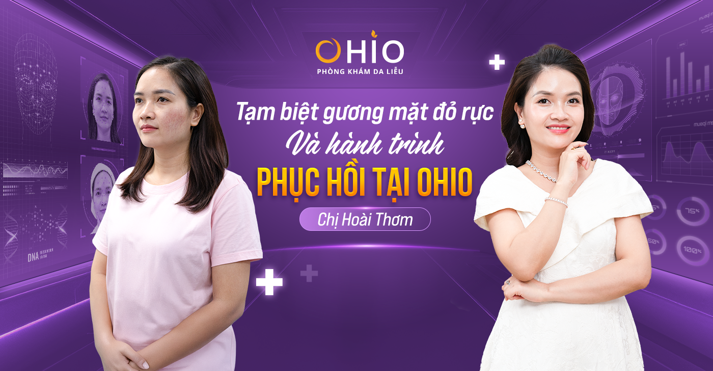 Tạm biệt gương mặt đỏ rực vì giãn mao mạch – Chị Hoài Thơm và hành trình hồi phục da tại OHIO