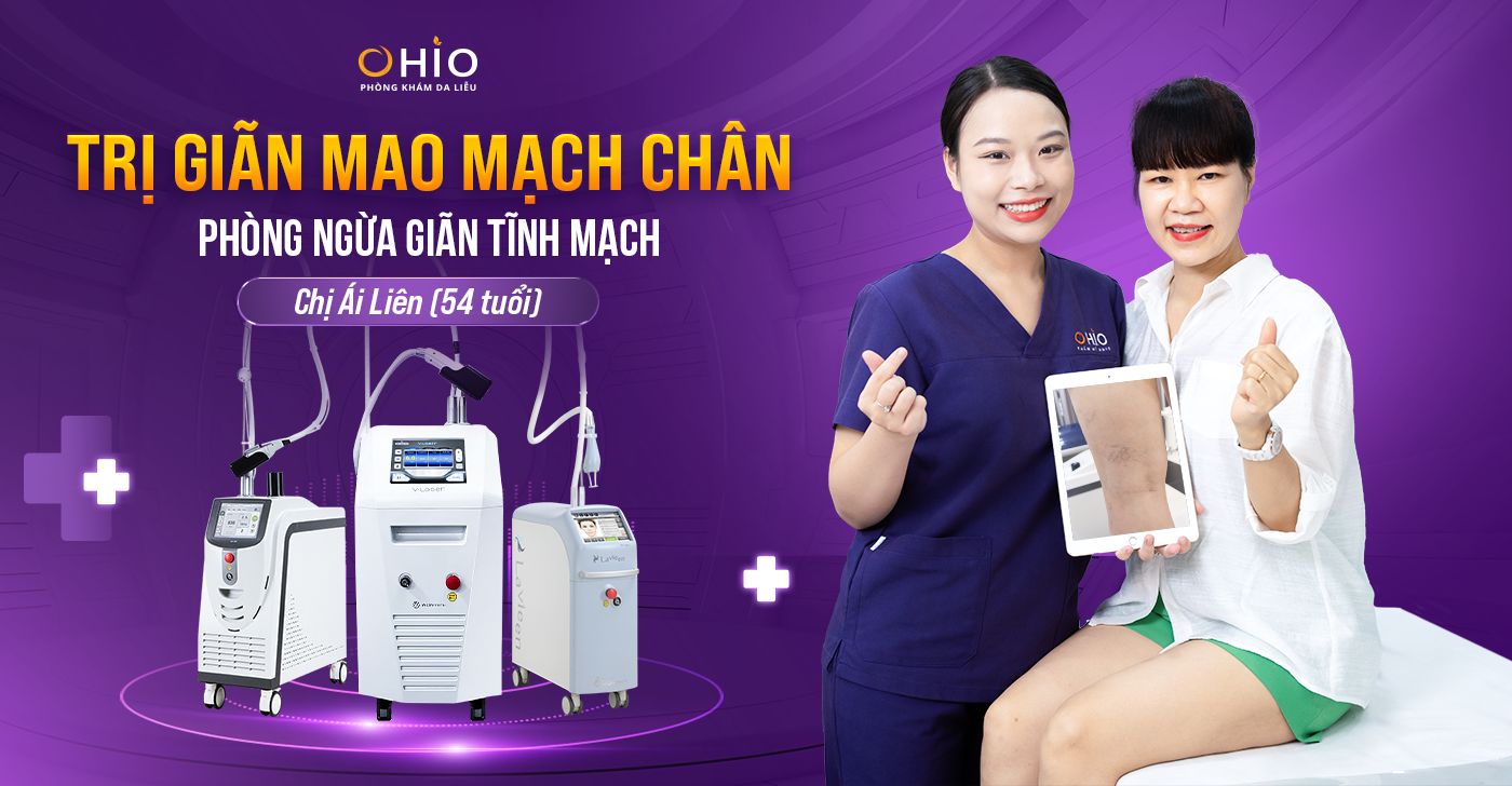 Trị giãn mao mạch chân phòng ngừa giãn tĩnh mạch (Chị Ái Liên – 54 tuổi)