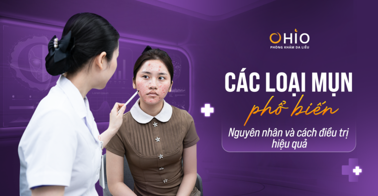 Các Loại Mụn Phổ Biến & Giải Pháp Trị Mụn Chuẩn Y Khoa Tại Phòng Khám Da Liễu OHIO