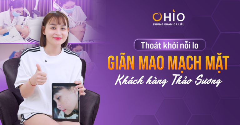 Bị giãn mao mạch mặt và hành trình thoát nỗi tự ti của chị Thảo Sương tại Phòng khám da liễu OHIO