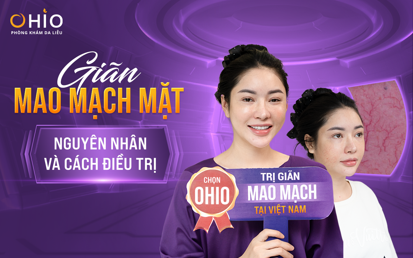 Giãn mao mạch mặt, nguyên nhân và cách điều trị