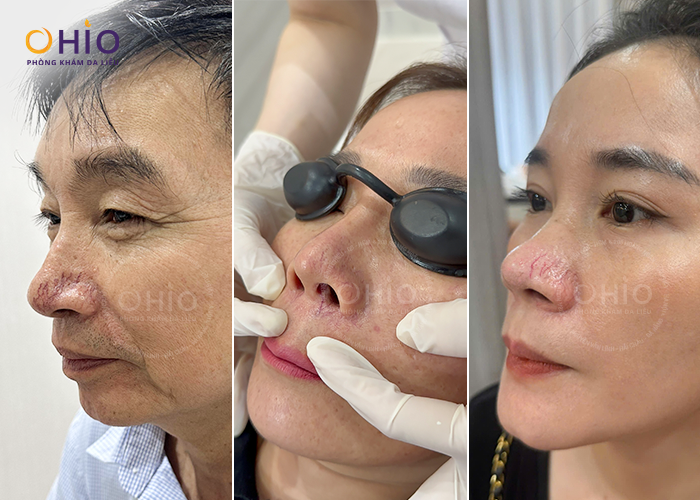 Giãn mao mạch mũi, Nguyên nhân và cách điều trị hiệu quả cao