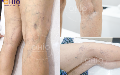 Điều trị giãn mao mạch vùng chân và đùi