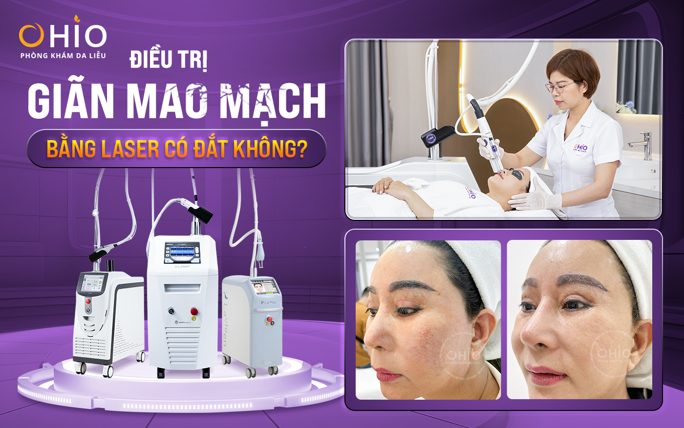 Điều trị giãn mao mạch bằng laser có đắt không?