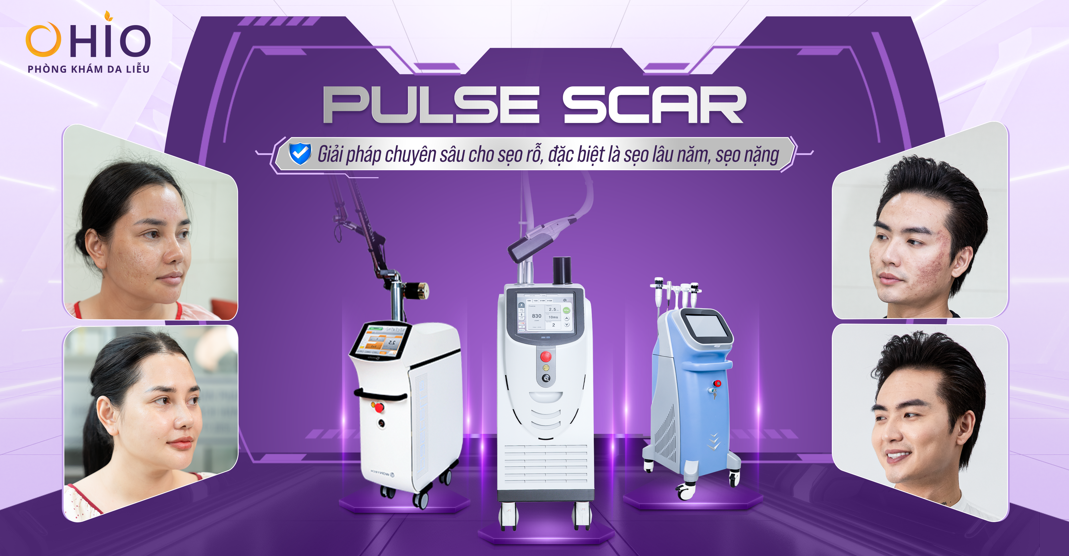 Trị Sẹo Rỗ Có Đau Không? Trải Nghiệm Tổ Hợp Công Nghệ Pulse Scar Tại OHIO