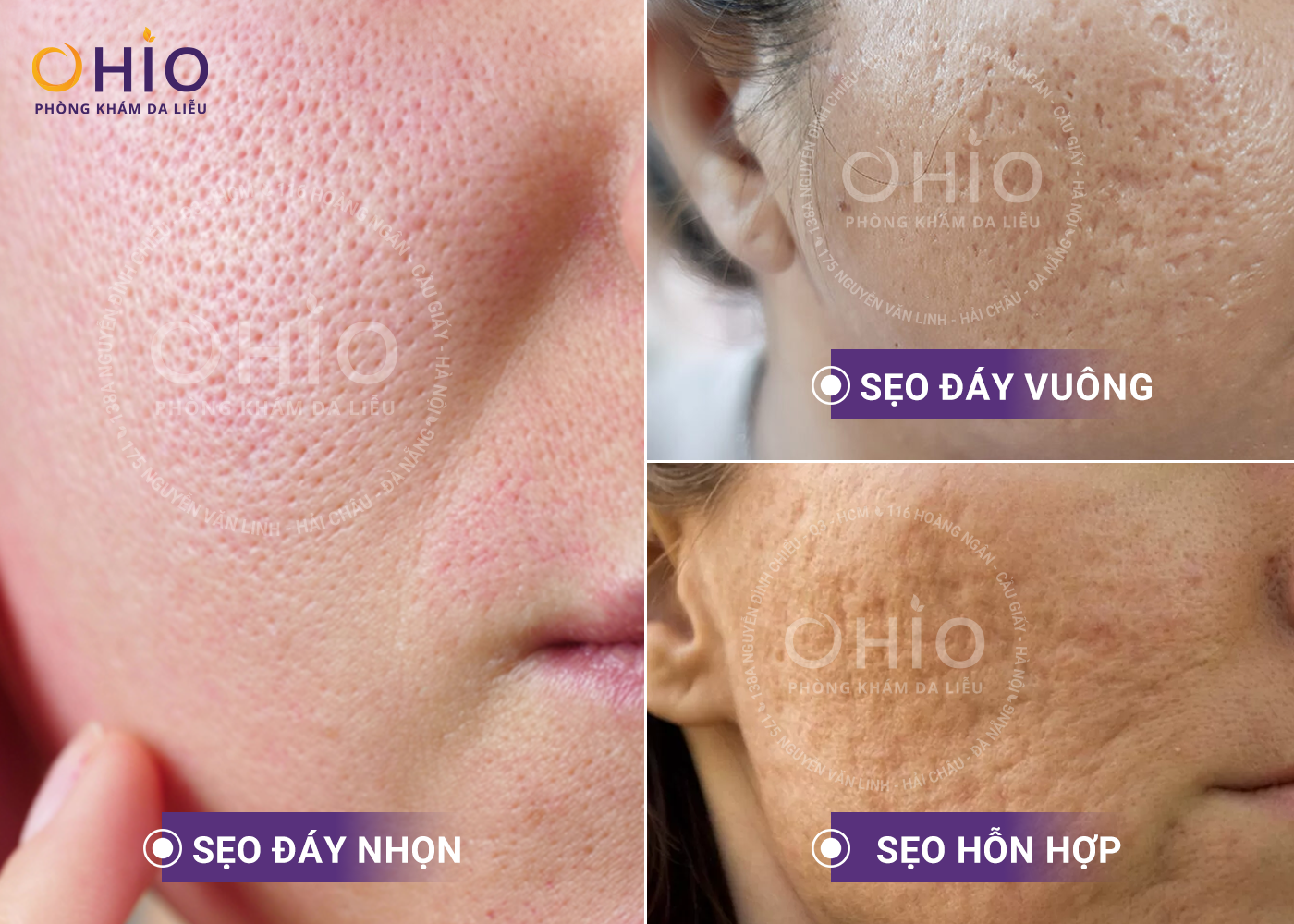 Điều trị sẹo rỗ - Phòng khám da liễu OHIO Các dạng sẹo rỗ đáy vuông và đáy tròn