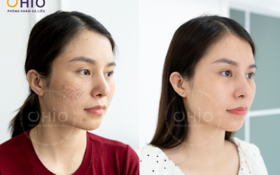 Điều trị sẹo rỗ