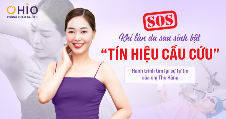 Điều trị vết thâm sạm trên da - Phòng khám da liễu OHIO Khi làn da sau sinh bật “tín hiệu cầu cứu” – Hành trình tìm lại sự tự tin của chị Thu Hằng