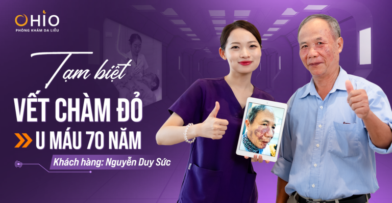 Xóa Sạch Chàm Đỏ, U Máu 70 Năm tại OHIO
