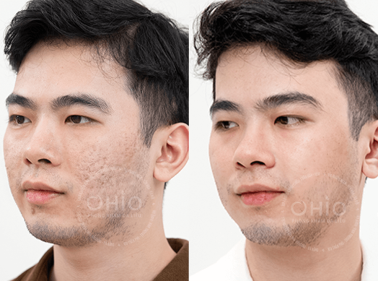 Anh Viết Cao đã xóa sạch sẹo rỗ do thủy đậu, hóa nam thần chỉ sau, tự tin hơn trong cuộc sống
