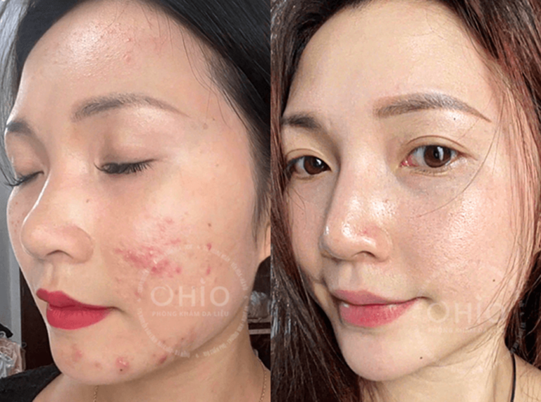 Chị Bích Ngọc đã xóa sạch sẹo rỗ do thay đổi nội tiết sau sinh, trở nên xinh đẹp, rạng ngời