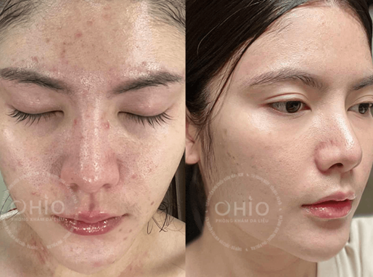 Chị Minh Thư đã xóa sạch sẹo rỗ lâu năm do mụn tuổi dậy thi, làn da căng bóng sáng mịn