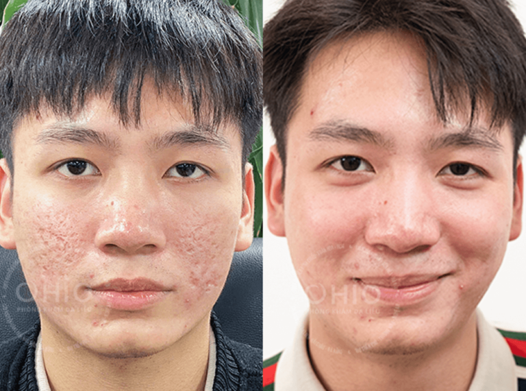 Anh Trường Giang đã xóa sạch sẹo rỗ 15 năm, thay đổi diện mạo, đón tương lai
