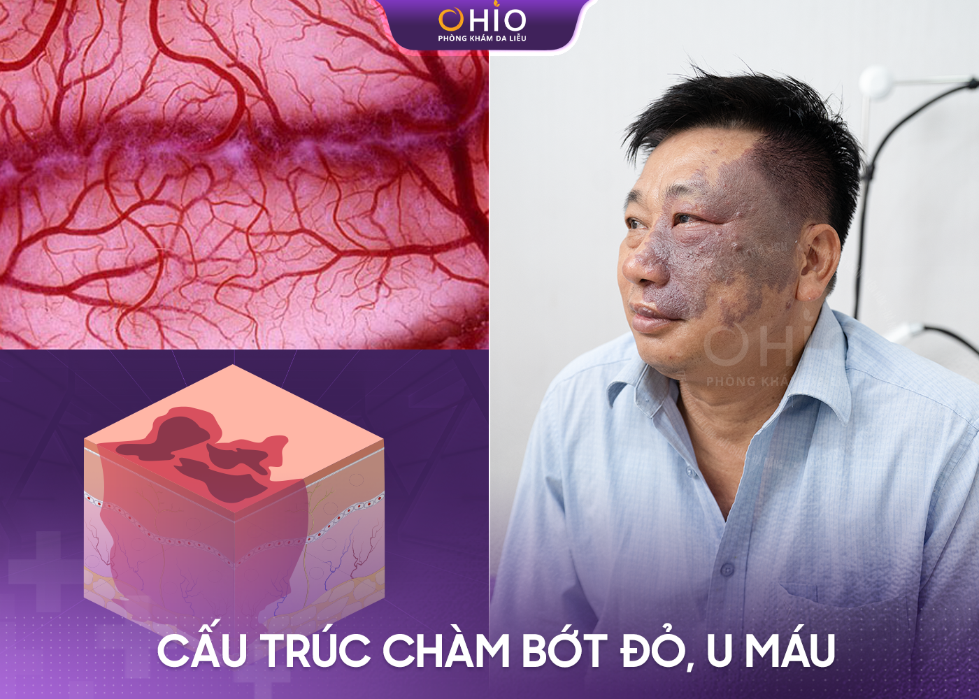 Điều trị chàm bớt đỏ - Phòng khám da liễu OHIO Cấu trúc chàm bớt đỏ, bớt rượu vang dưới da