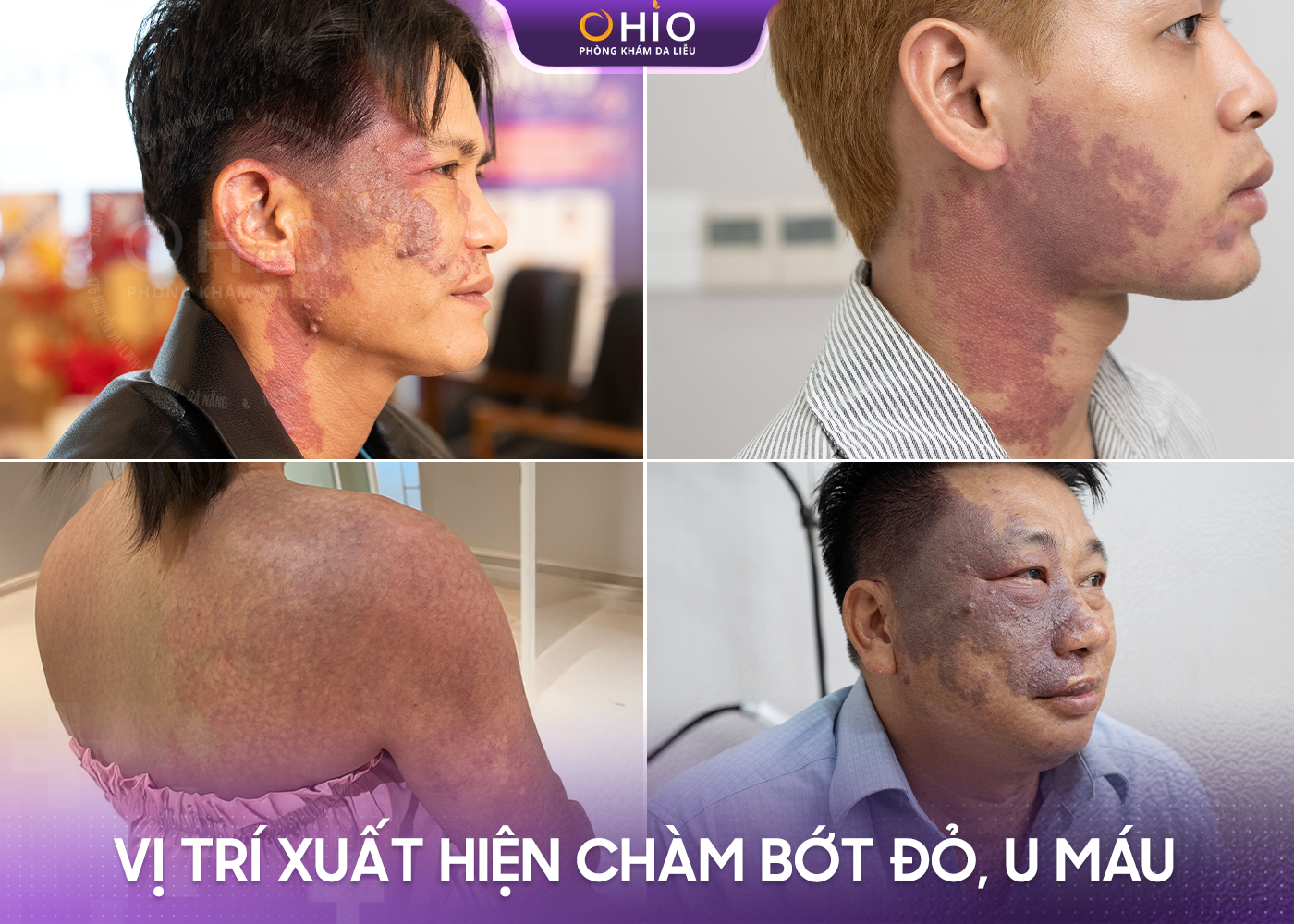 Điều trị chàm bớt đỏ - Phòng khám da liễu OHIO Các vị trí chàm bớt đỏ thường xuất hiện