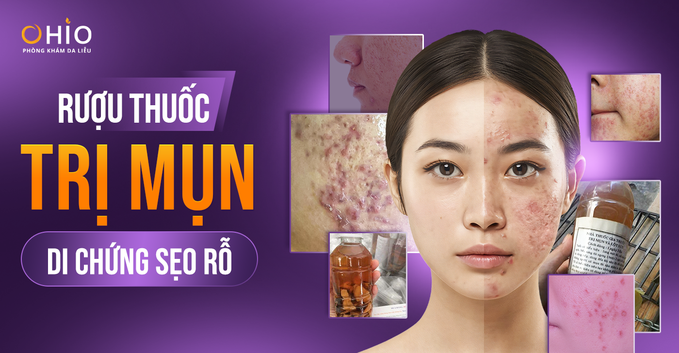 Từ Rượu Thuốc Trị Mụn Đến Di Chứng Sẹo Rỗ: Hành Trình Phục Hồi Làn Da Của chị Thu Huyền